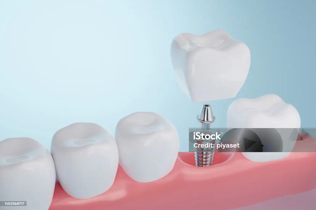 Dental Implants