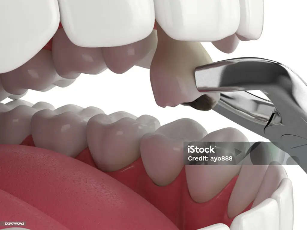 Extractions